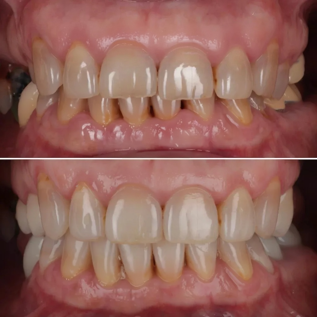 You are currently viewing Bruxisme usure des dents : Comment protégez votre émail?